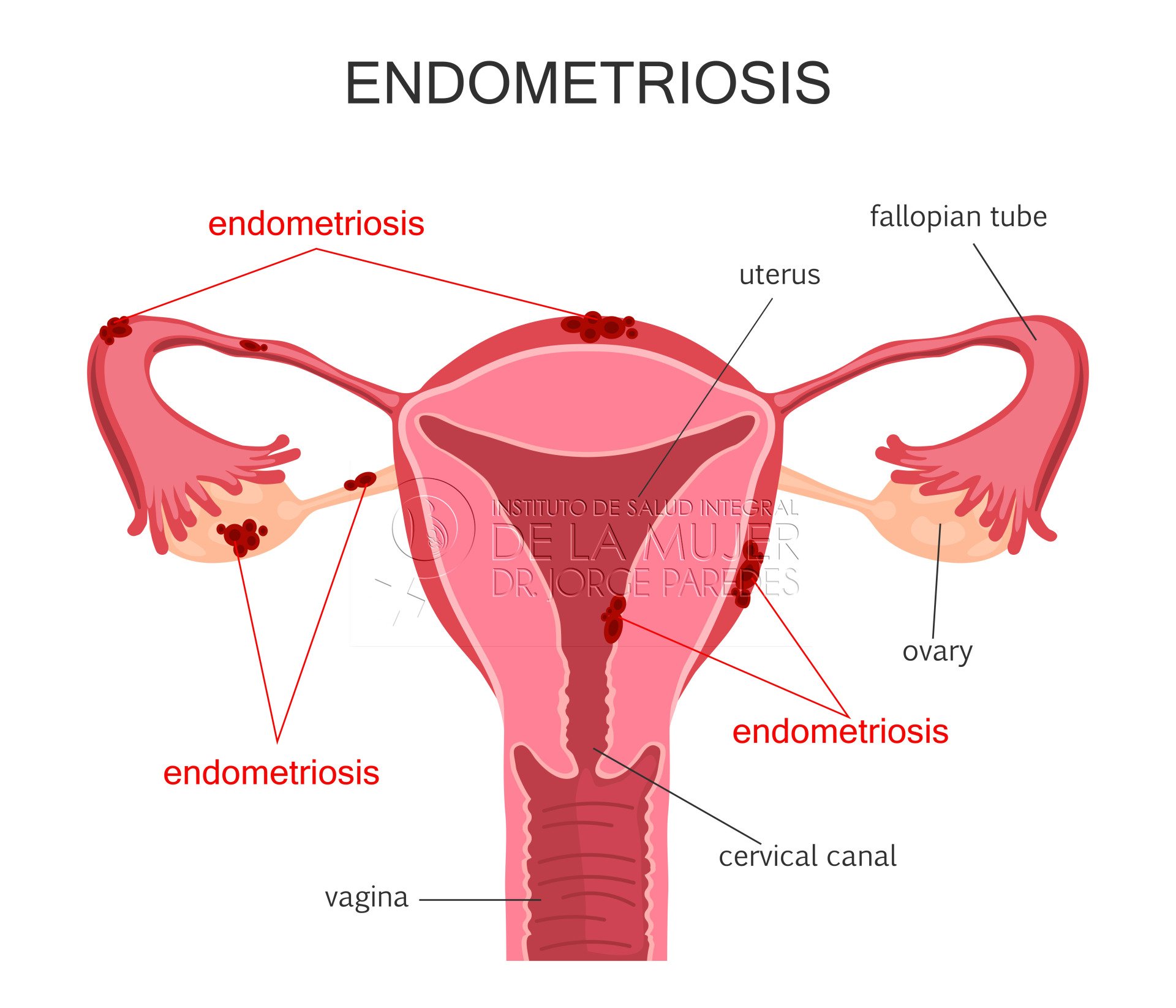 Endometrio dolor cronico